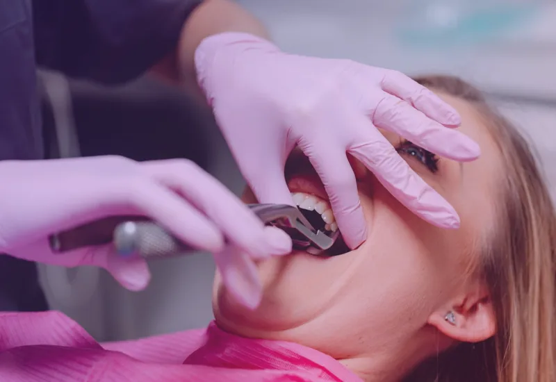 Dentista realizando una extracción dental con fórceps a una paciente
