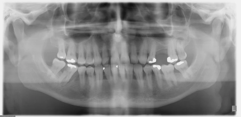 Radiografía panorámica dental para diagnóstico de urgencia - Urgencias dentales en Legazpi